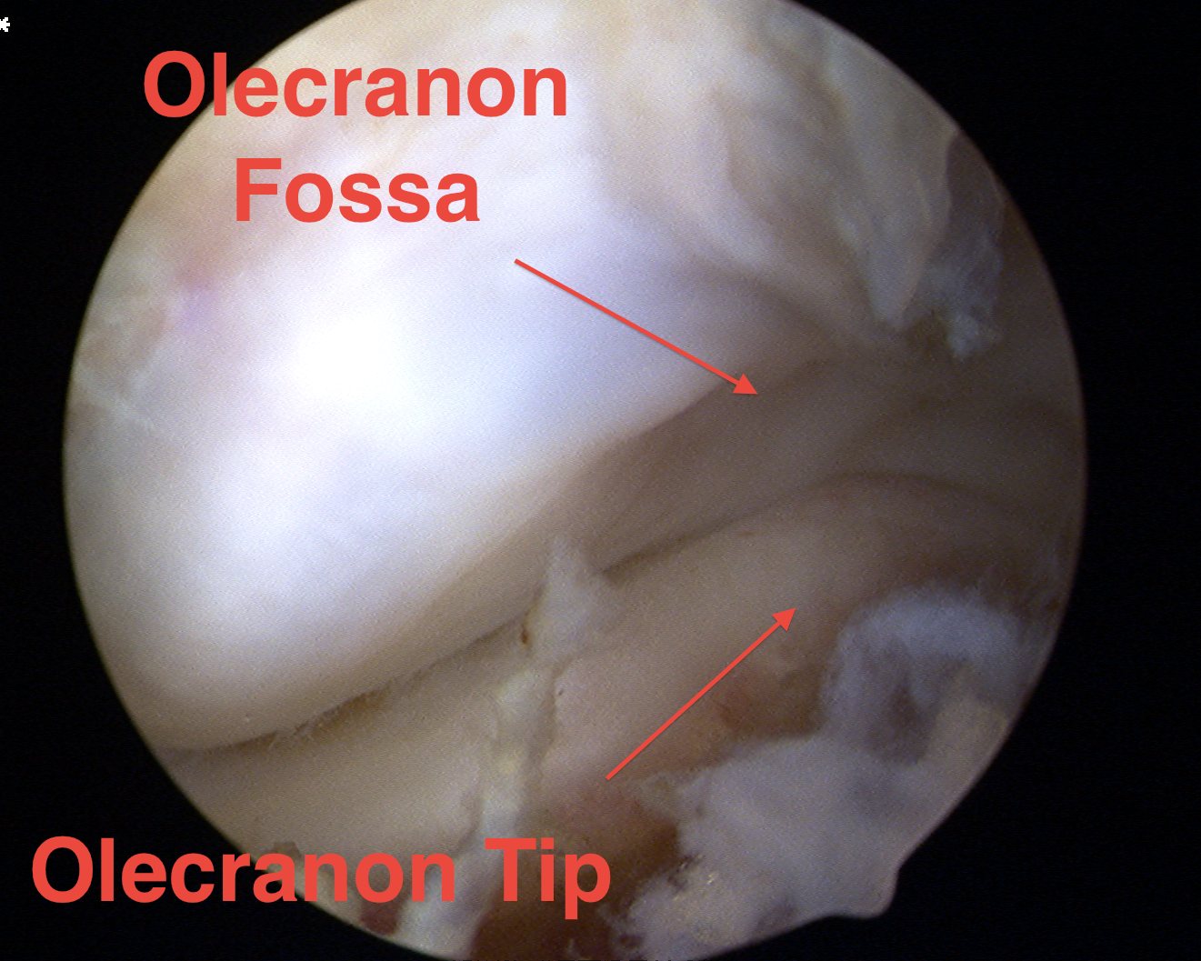 Elbow Arthroscopy Posterior Compartment